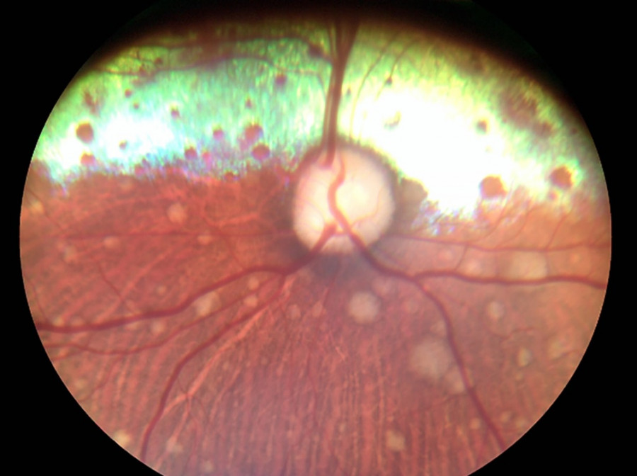 Retina